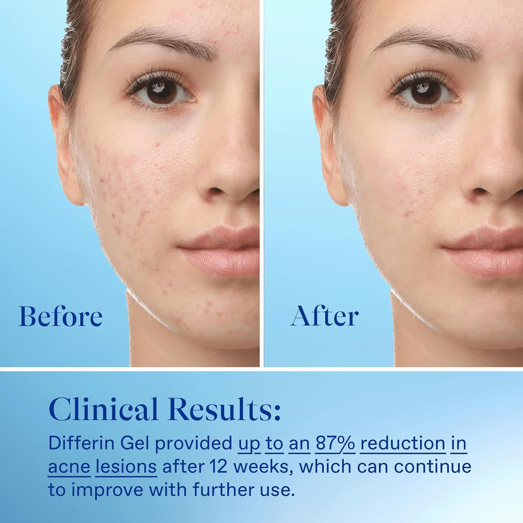 Differin Acne Treatment Gel - 30 Day Supply | 0.1% Adapalene Retinoid for Acne-Prone, Sensitive Skin | Clears & Prevents Breakouts | 15g Tube - Ballimart