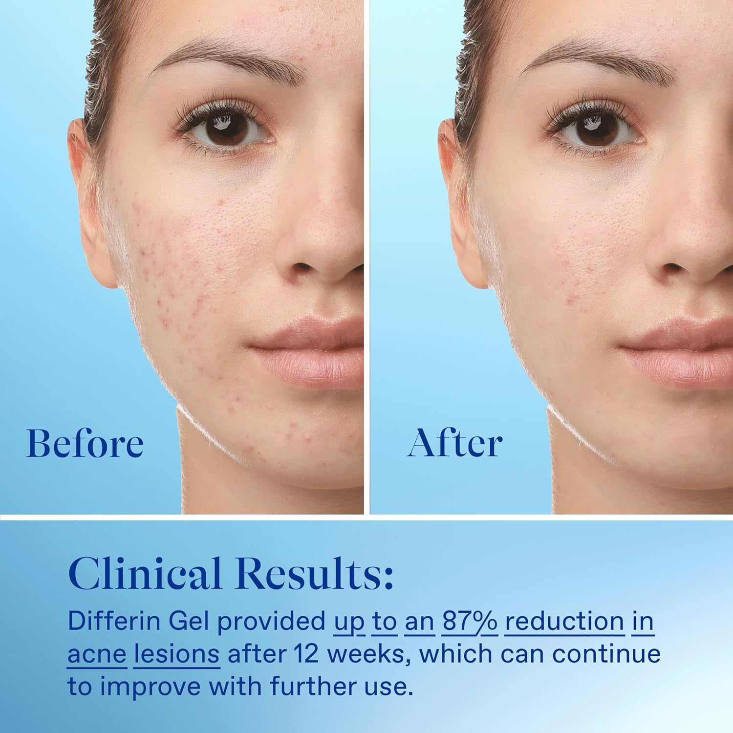 Differin Acne Treatment Gel - 30 Day Supply | 0.1% Adapalene Retinoid for Acne-Prone, Sensitive Skin | Clears & Prevents Breakouts | 15g Tube - Ballimart