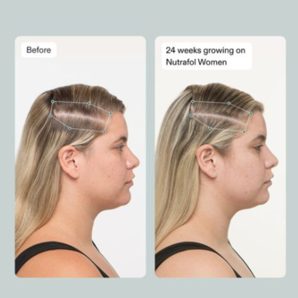 Nutrafol Women's Hair Growth Supplements, Ages 18-44, Clinically Proven, 1-Month Supply - Ballimart